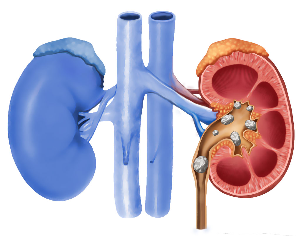 Мочекаменное заболевание почек. Мочекаменная болезнь камни в почках. Локализация камней в почках. Камни в почках (конкременты).